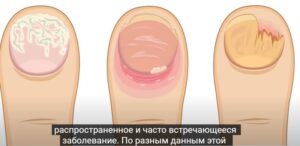 Неумывакин: ЭТОТ ПРОСТОЙ РЕЦЕПТ избавит от ГРИБКА — навсегда!  Видео