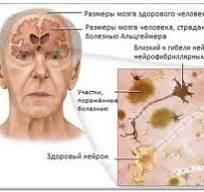 Израиль  В Израиле удалось победить болезнь Альцгеймера