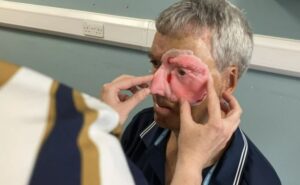 В Великобритании для пострадавшего в аварии велосипедиста напечатали на 3D-принтере часть лица