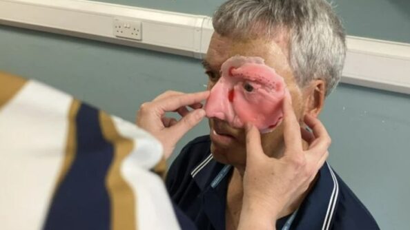 В Великобритании для пострадавшего в аварии велосипедиста напечатали на 3D-принтере часть лица