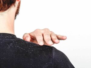 Здоровые волосы – это просто: избавляемся от перхоти навсегда