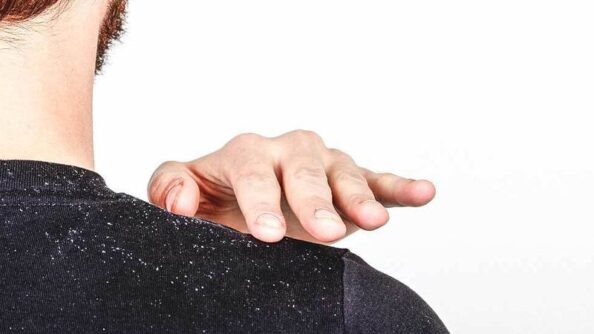 Здоровые волосы – это просто: избавляемся от перхоти навсегда